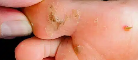 foot warts treatment.jpg
