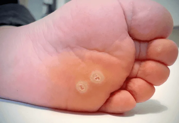 Close-up of plantar warts on the sole of the foot in Bridgewater NJ