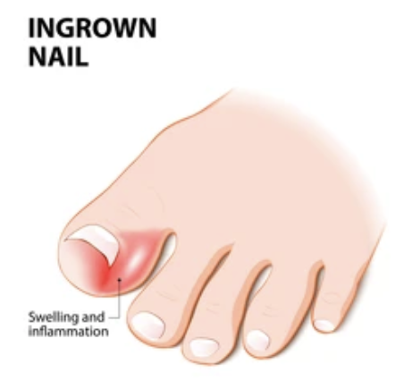ingrown nail picture