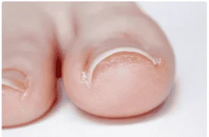 Ingrown Toenails