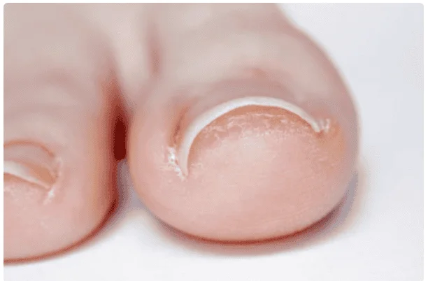 Ingrown Toenails