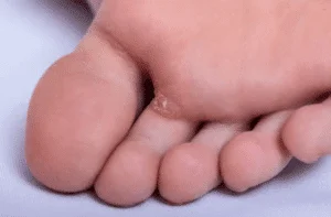 Plantar Warts on a foot