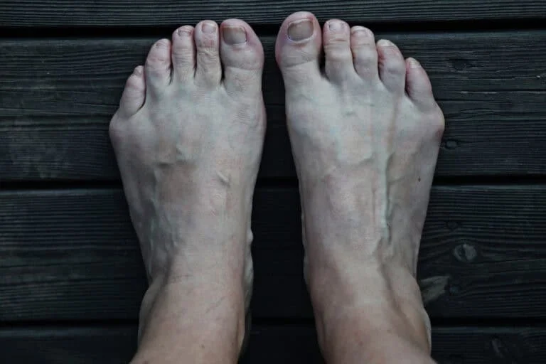 picture of a foot tailor's bunionette
