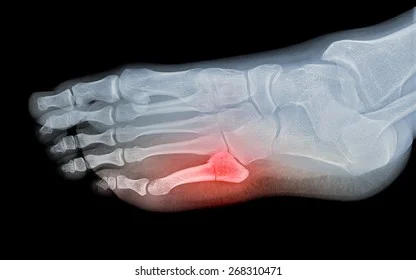 xray image bone fracture 260nw 268310471